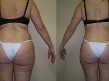  Sharko zuhany a karcsúsításhoz, anti-cellulit - előtte és utána fotók