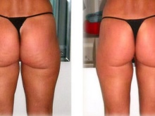  Charcot zuhany karcsúsításhoz, cellulit elleni - előtte és utána fotók