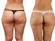 Charcot zuhany - előtte és utána