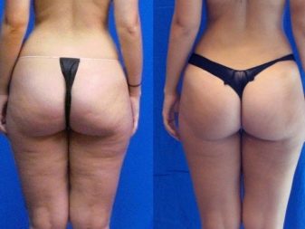 Charcot zuhany: előtte és utána fotók - cellulitisz a fenéken