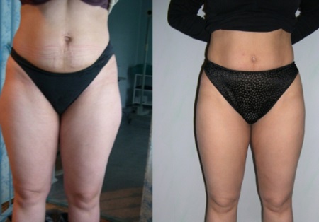  Charcot zuhany karcsúsításhoz, cellulit elleni - előtte és utána fotók