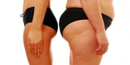  Charcot zuhany karcsúsításhoz, cellulit eltávolításhoz - előtte és utána képek