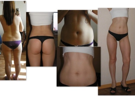 Charcot zuhany hatás - előtte és utána fotók