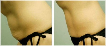 Símább bőr a Charcot zuhanyzóval